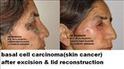 Before After Pictures,Delhi,skin cancer bcc 